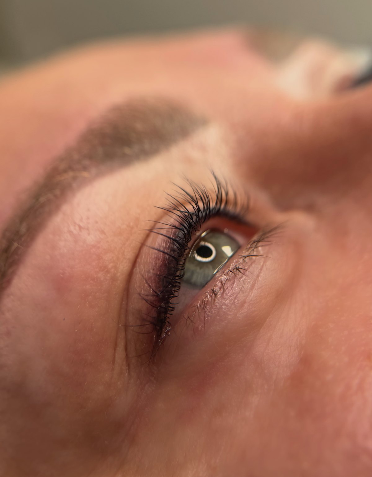 Abgeheilte Wimpernkranzverdichtung am oberen Lidrand