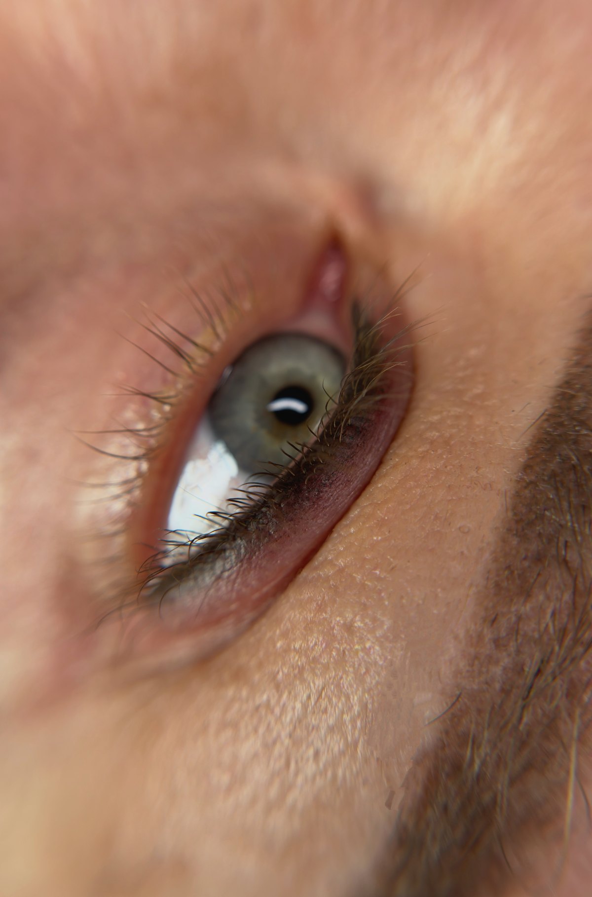 Frische Wimpernkranzverdichtung direkt nach der Behandlung